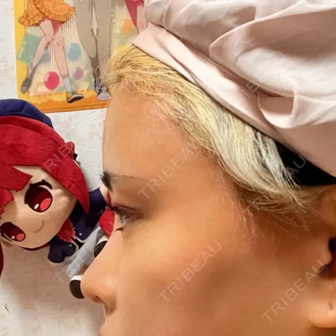 クマ治療 / 脂肪注入（額） / 脂肪注入（輪郭） X CLINIC 名古屋院 DAY 53 メイン用