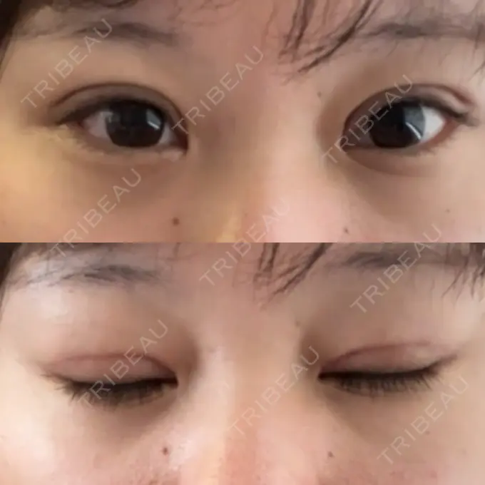 二重切開 / 眼瞼下垂（切開） エターナル美容クリニック AFTER メイン用