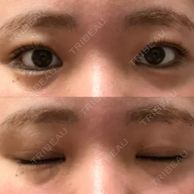 上まぶたの脂肪取り 湘南美容クリニック 大阪なんば院 DAY 6 メイン用