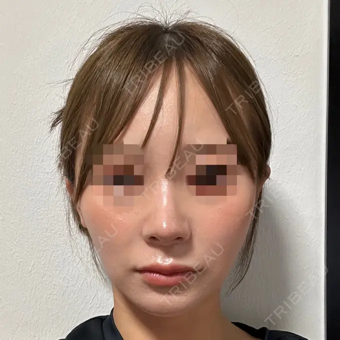 隆鼻術 / 鼻尖形成（切開） / 鼻中隔延長（切開） / 軟骨移植 / 鼻修正 / 鼻孔縁下降 / その他（鼻） Designo Clinic （デジーノクリニック） DAY 25 メイン用