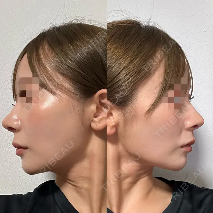 隆鼻術 / 鼻尖形成（切開） / 鼻中隔延長（切開） / 軟骨移植 / 鼻修正 / 鼻孔縁下降 / その他（鼻） Designo Clinic （デジーノクリニック） DAY 25 メイン用