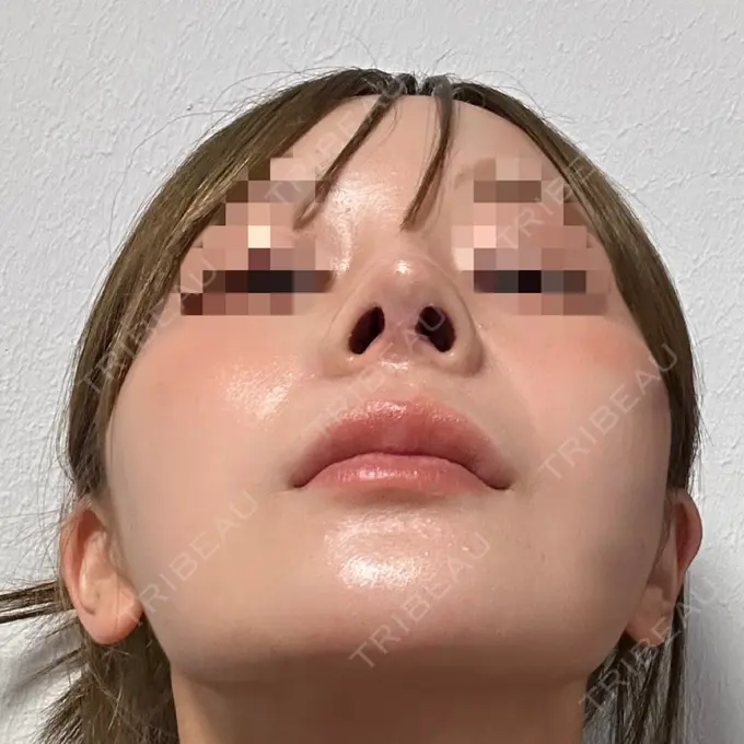 隆鼻術 / 鼻尖形成（切開） / 鼻中隔延長（切開） / 軟骨移植 / 鼻修正 / 鼻孔縁下降 / その他（鼻） Designo Clinic （デジーノクリニック） DAY 25 メイン用