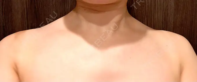 ボトックス（肩） 日比谷セントラルクリニック AFTER メイン用