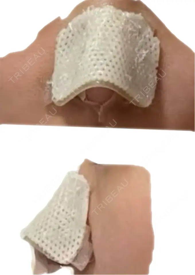 鼻中隔延長（切開） こいずみ形成クリニック名古屋 DAY 6 メイン用