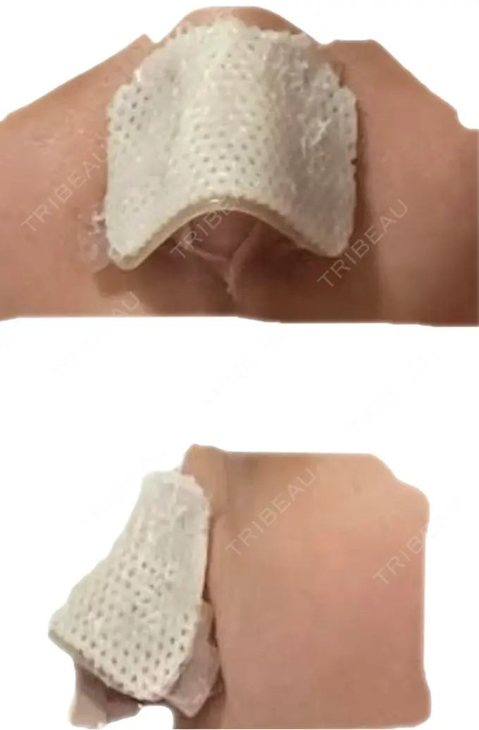 鼻中隔延長（切開） こいずみ形成クリニック名古屋 DAY 5 メイン用