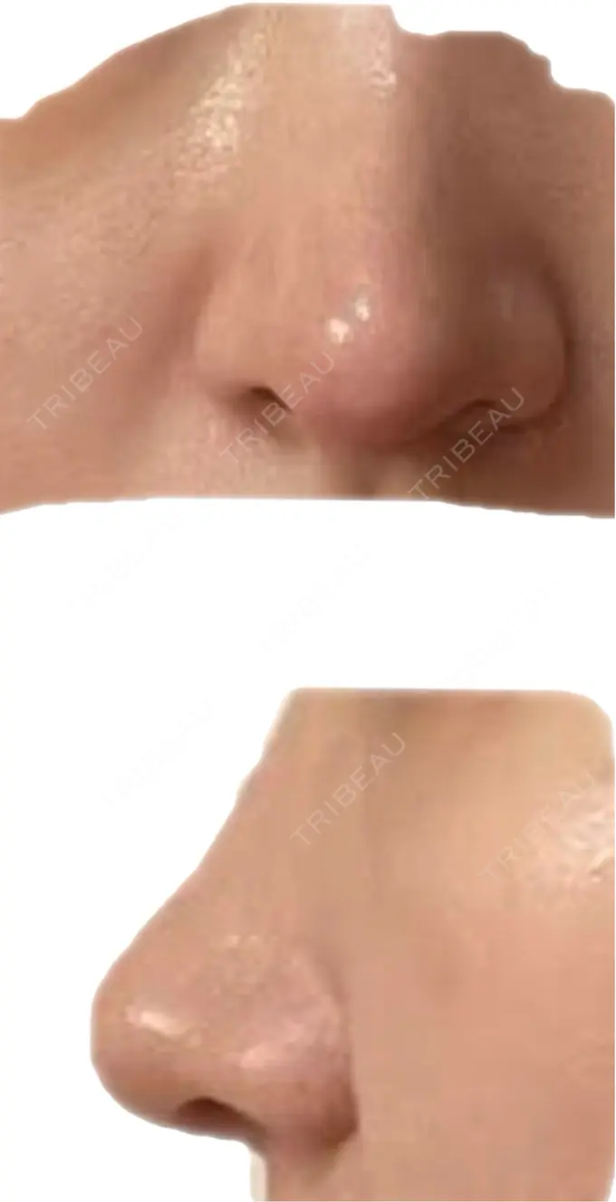 鼻中隔延長（切開） こいずみ形成クリニック名古屋 DAY 14 メイン用