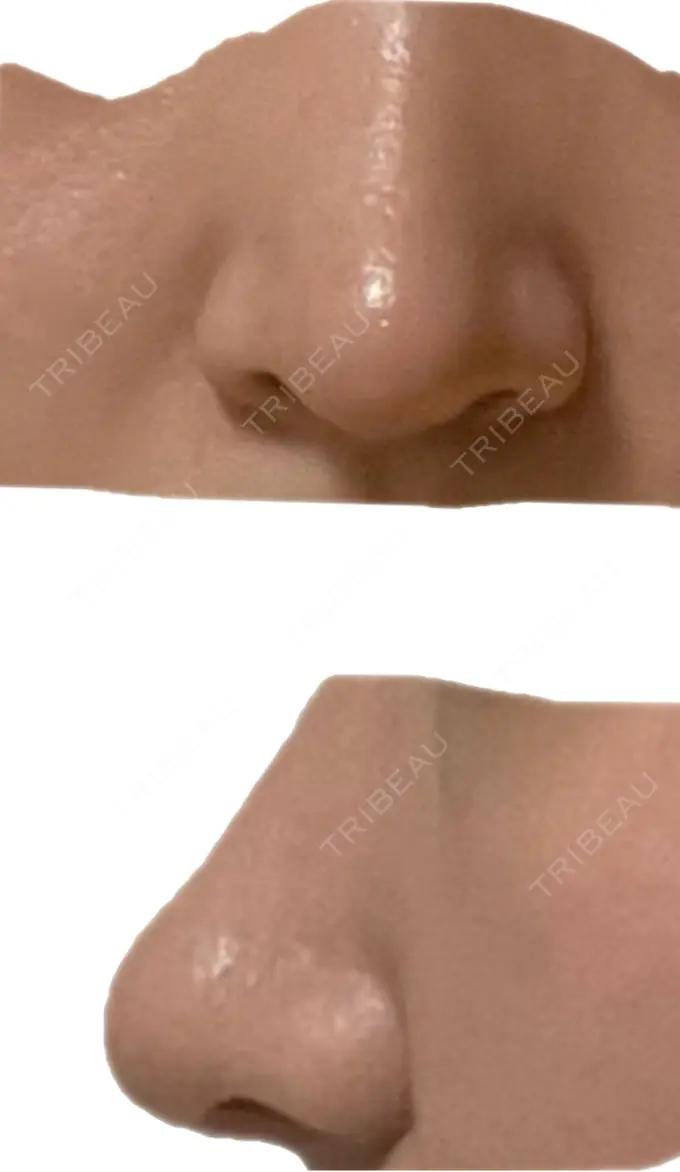 鼻中隔延長（切開） こいずみ形成クリニック名古屋 DAY 28 メイン用