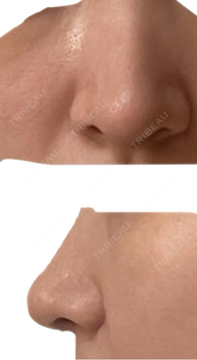鼻中隔延長（切開） こいずみ形成クリニック名古屋 DAY 42 メイン用
