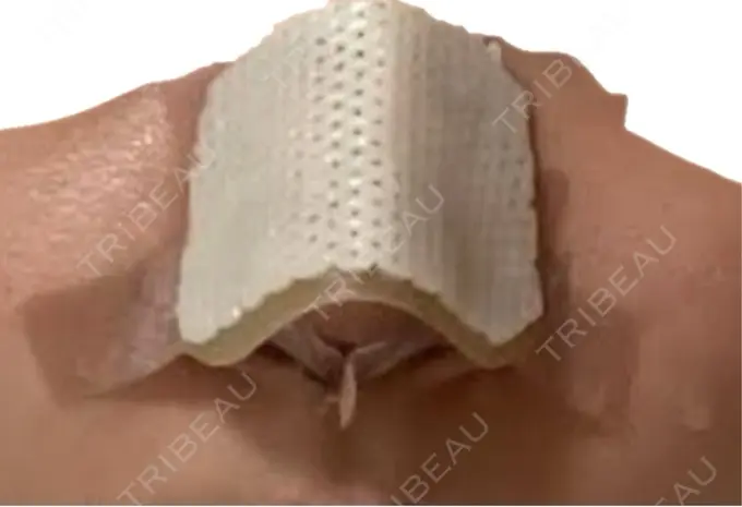 鼻中隔延長（切開） こいずみ形成クリニック名古屋 DAY 3 メイン用