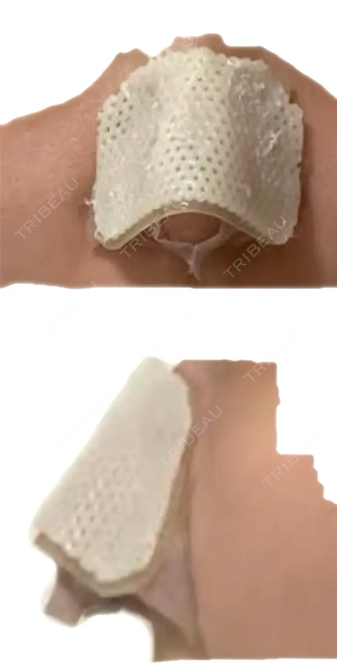 鼻中隔延長（切開） こいずみ形成クリニック名古屋 DAY 4 メイン用