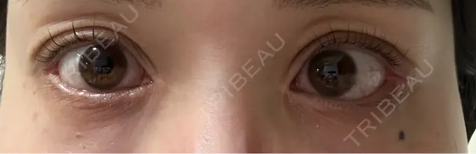 目尻靭帯移動 アネシス美容クリニック AFTER メイン用