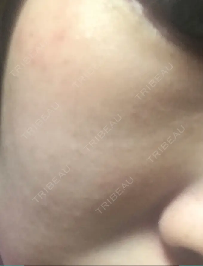 シミ取りレーザー 仁愛クリニック DAY 19 メイン用