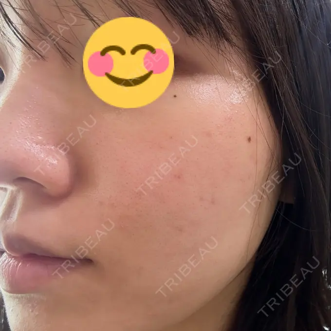 その他（肌） / ピーリング（ニキビ・毛穴） / エレクトロポレーション 新宿美容外科クリニック 新宿院 AFTER メイン用