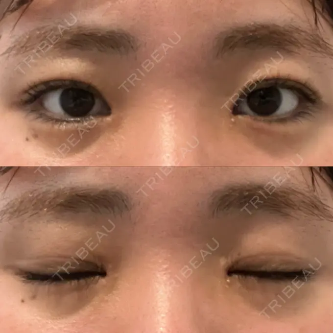 上まぶたの脂肪取り 湘南美容クリニック 大阪なんば院 DAY 8 メイン用