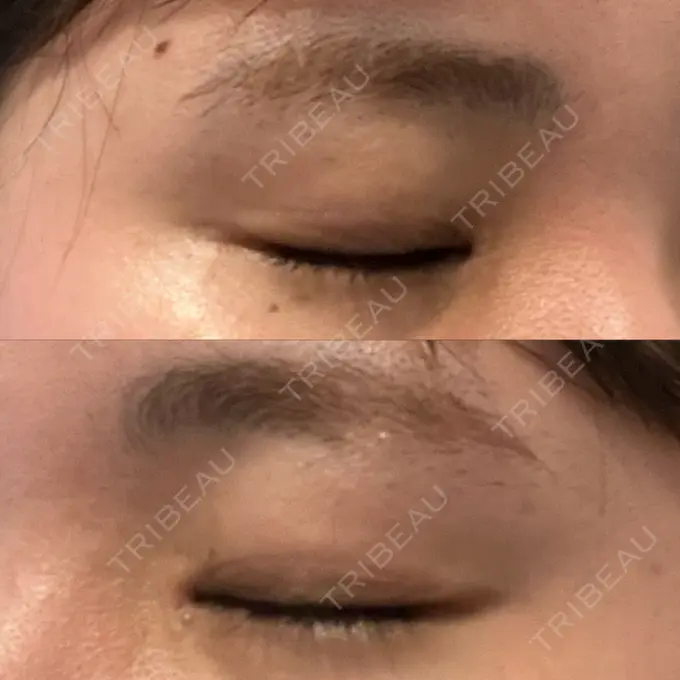 上まぶたの脂肪取り 湘南美容クリニック 大阪なんば院 DAY 8 メイン用