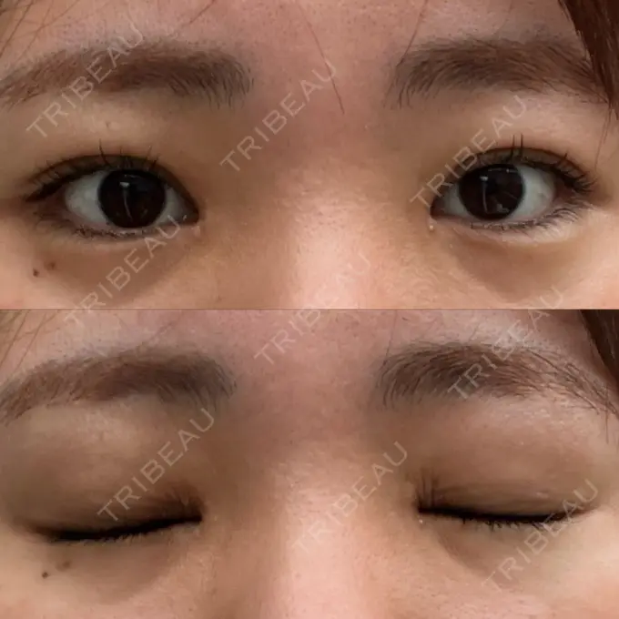 上まぶたの脂肪取り 湘南美容クリニック 大阪なんば院 DAY 9 メイン用