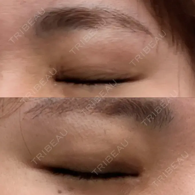 上まぶたの脂肪取り 湘南美容クリニック 大阪なんば院 DAY 9 メイン用