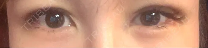 二重埋没 / 上まぶたの脂肪取り 恵聖会クリニック 梅田院 DAY 3 メイン用