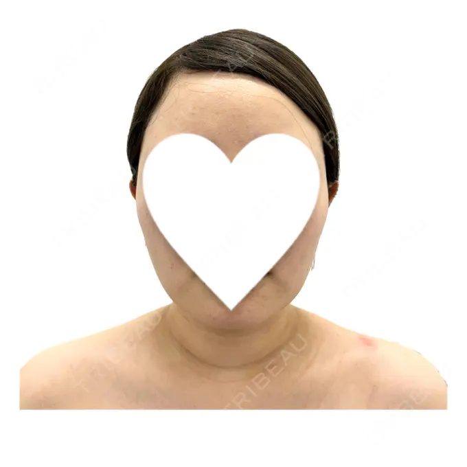 ボトックス（エラ・小顔） / ボトックス（肩） / ワキ汗治療（ボトックス） DMTC CLINIC 日本橋院 DAY 7 メイン用