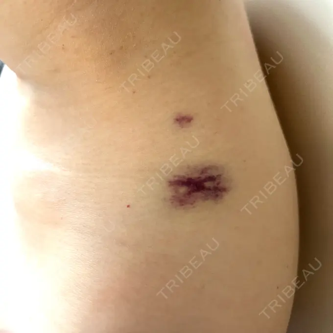 ボトックス（エラ・小顔） / ボトックス（肩） / ワキ汗治療（ボトックス） DMTC CLINIC 日本橋院 AFTER メイン用