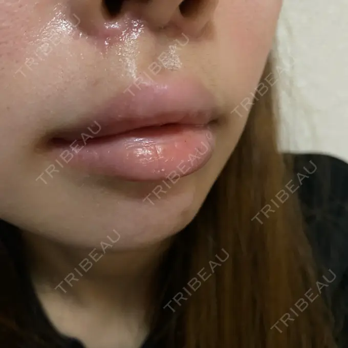 人中短縮 / ボトックス（人中） 新宿ラクル美容外科クリニック 新宿院 DAY 17 メイン用