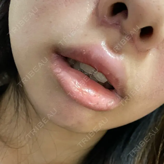 人中短縮 / ボトックス（人中） 新宿ラクル美容外科クリニック 新宿院 DAY 17 メイン用