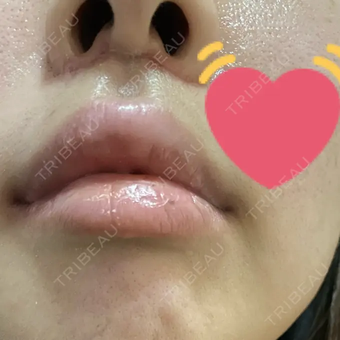 人中短縮 / ボトックス（人中） 新宿ラクル美容外科クリニック 新宿院 DAY 17 メイン用