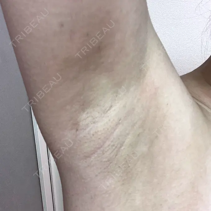 ワキ汗治療（レーザー） Fellez Clinic【フェルズクリニック】 DAY 31 メイン用