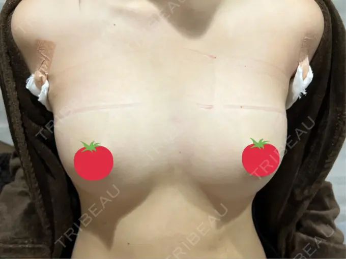 豊胸（シリコンバッグ） / ワキ汗治療（ボトックス） MYCLI【マイクリ】東京・恵比寿院 DAY 0 メイン用