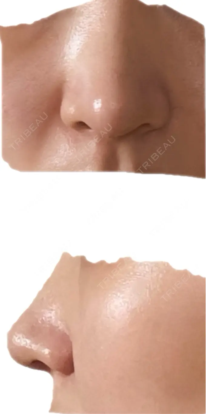 鼻中隔延長（切開） こいずみ形成クリニック名古屋 AFTER メイン用