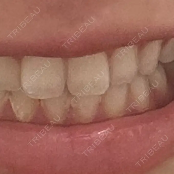 ホワイトニング LEAGRANT CLINIC 中目黒 AFTER メイン用