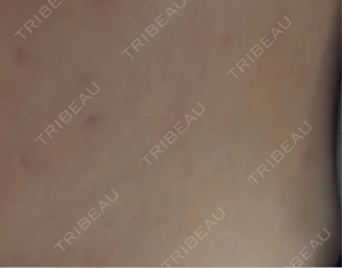 ほくろ・いぼ除去レーザー（肌） 白金ビークリニック 本院 AFTER メイン用