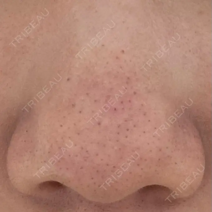 毛穴洗浄（ハイドラフェイシャルなど） 美容皮膚科エルムクリニック 神戸院 AFTER メイン用