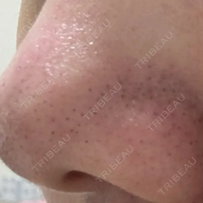 毛穴洗浄（ハイドラフェイシャルなど） 美容皮膚科エルムクリニック 神戸院 DAY 0 メイン用