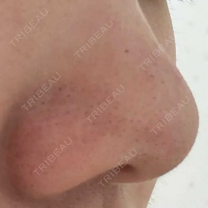 毛穴洗浄（ハイドラフェイシャルなど） 美容皮膚科エルムクリニック 神戸院 DAY 0 メイン用