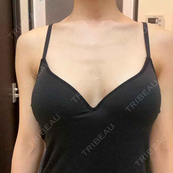 豊胸（シリコンバッグ） ジョウクリニック 那覇院 DAY 11 メイン用