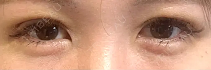 二重埋没 / 上まぶたの脂肪取り 恵聖会クリニック 梅田院 DAY 4 メイン用