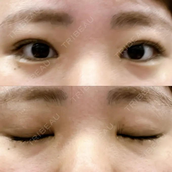 上まぶたの脂肪取り 湘南美容クリニック 大阪なんば院 AFTER メイン用