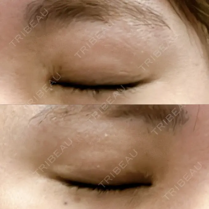 上まぶたの脂肪取り 湘南美容クリニック 大阪なんば院 DAY 11 メイン用