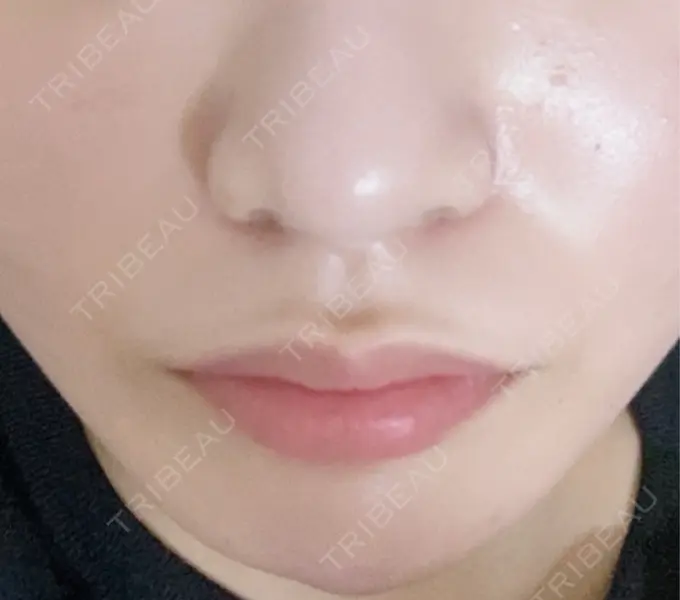 脂肪吸引注射（顔） / その他（鼻） 吉祥寺アイビークリニック DAY 19 メイン用