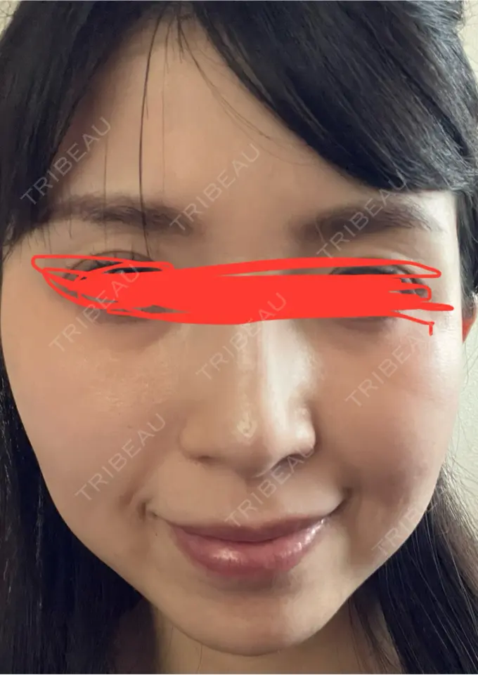 ルメッカ ルラ美容クリニック 名古屋本院 DAY 3 メイン用