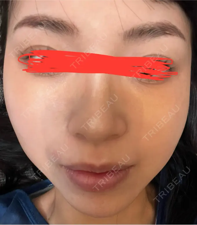 ルメッカ ルラ美容クリニック 名古屋本院 DAY 4 メイン用