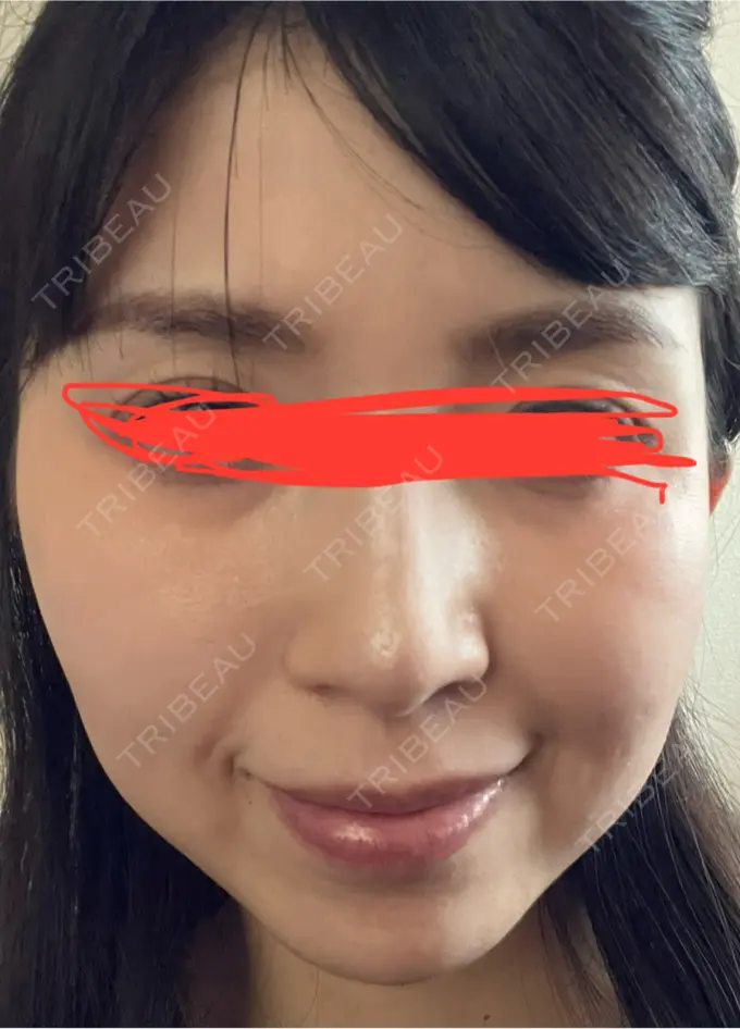 イオン導入 ルラ美容クリニック 名古屋本院 DAY 3 メイン用