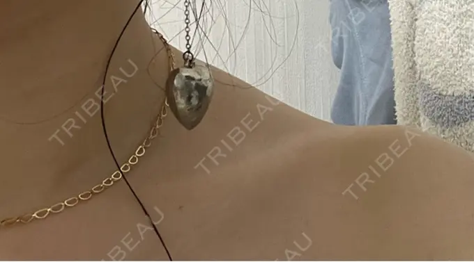 ボトックス（肩） MYCLINIC 西新宿 AFTER メイン用