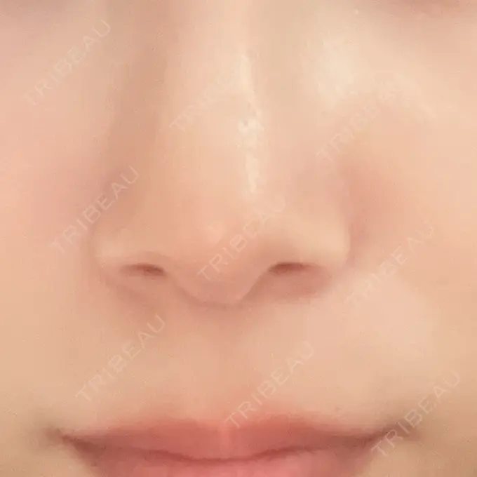 その他（鼻） ROOTS Clinic AFTER メイン用