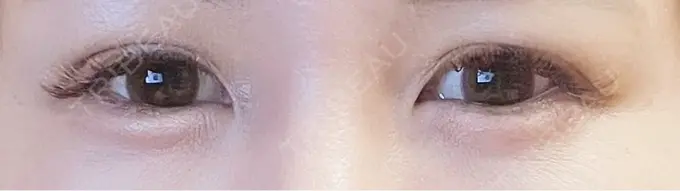 二重埋没 / 上まぶたの脂肪取り 恵聖会クリニック 梅田院 DAY 5 メイン用