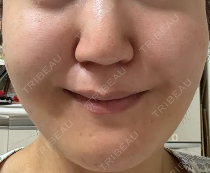 脂肪吸引（顔） スノウ（Snow）整形外科 AFTER メイン用