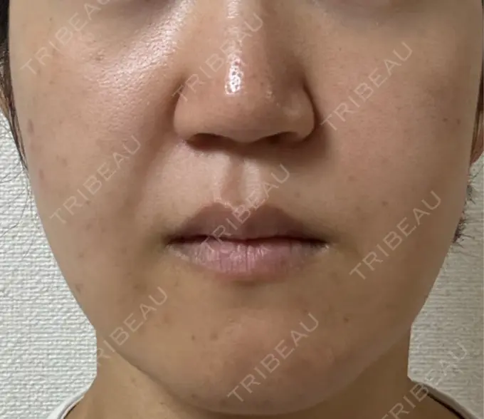 脂肪吸引（顔） スノウ（Snow）整形外科 DAY 57 メイン用