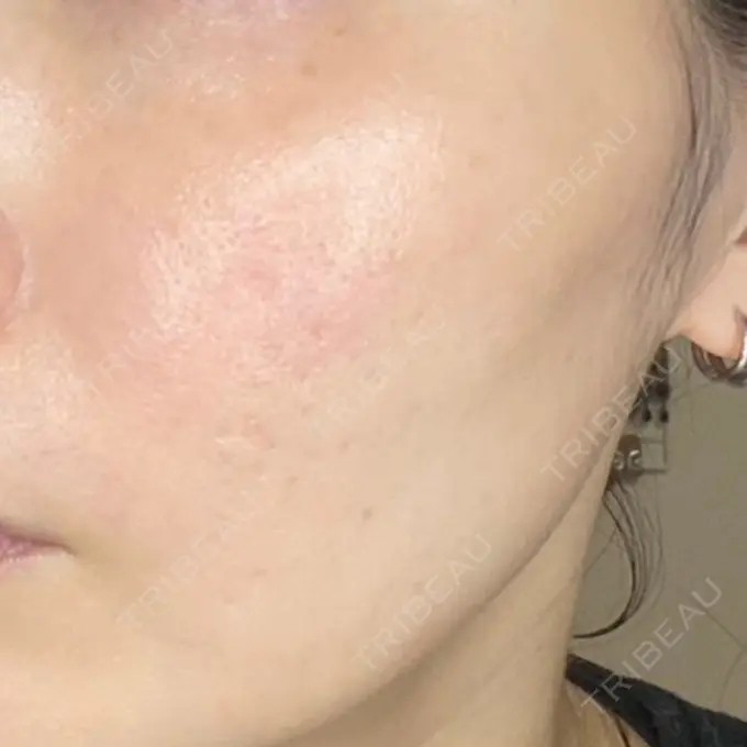 その他（肌） / ポテンツァ 東京美容外科 京都河原町院 DAY 1 メイン用