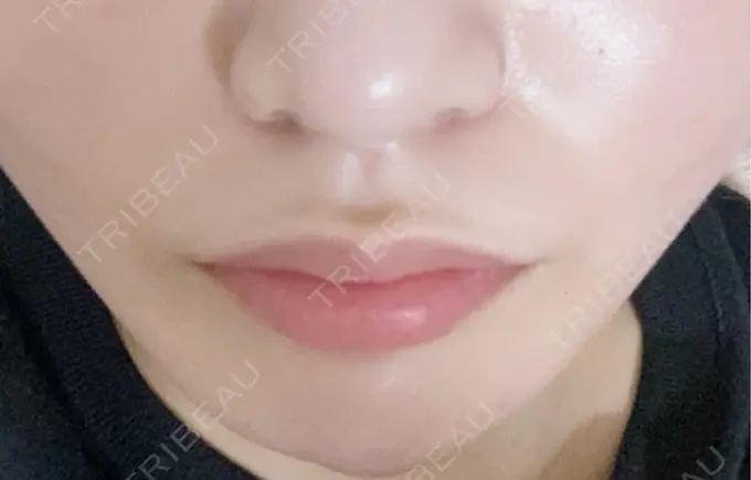 脂肪吸引注射（顔） / その他（鼻） 吉祥寺アイビークリニック AFTER メイン用